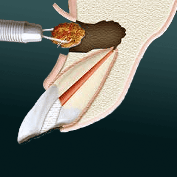 ENDODONTIC SURGERY