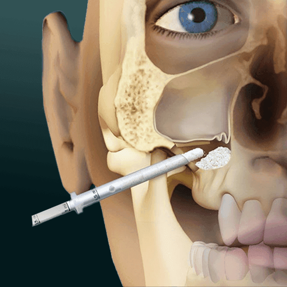 SINUS LIFTING