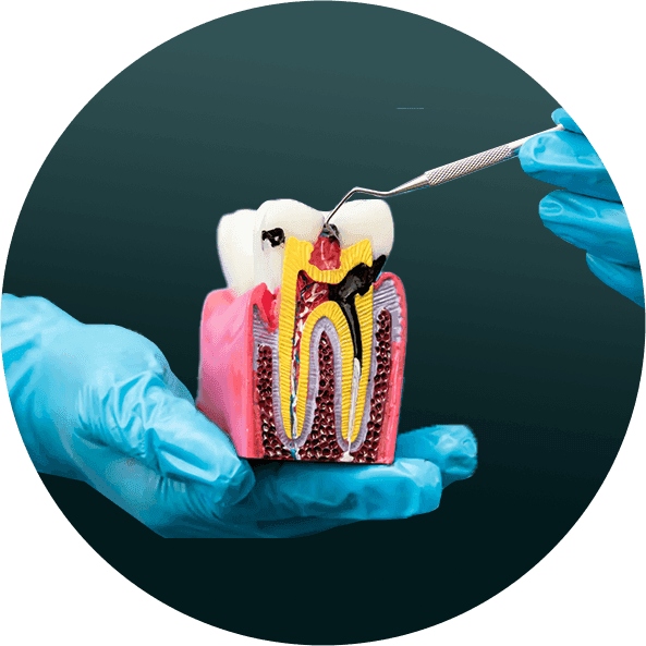 ROOT CANAL TREATMENT
