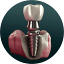 Dental Implants illustration