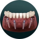 ALL ON FOUR IMPLANTS illustration