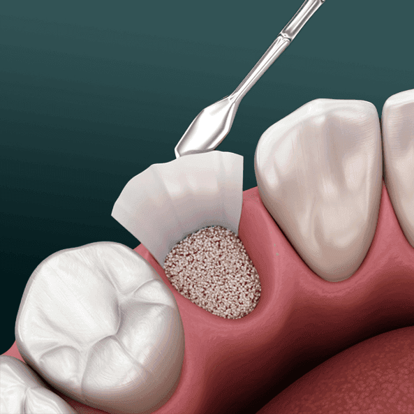 BONE GRAFT