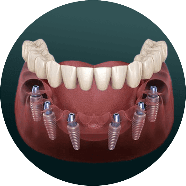 Dental Implant Packages illustration