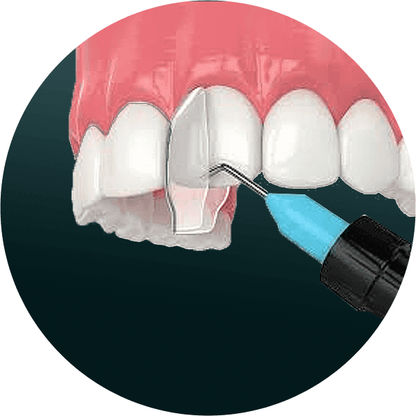 COMPOSITE BONDING