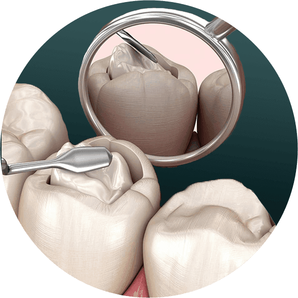 FILLINGS