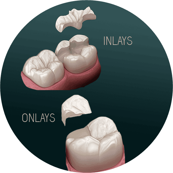 INLAYS ONLAYS