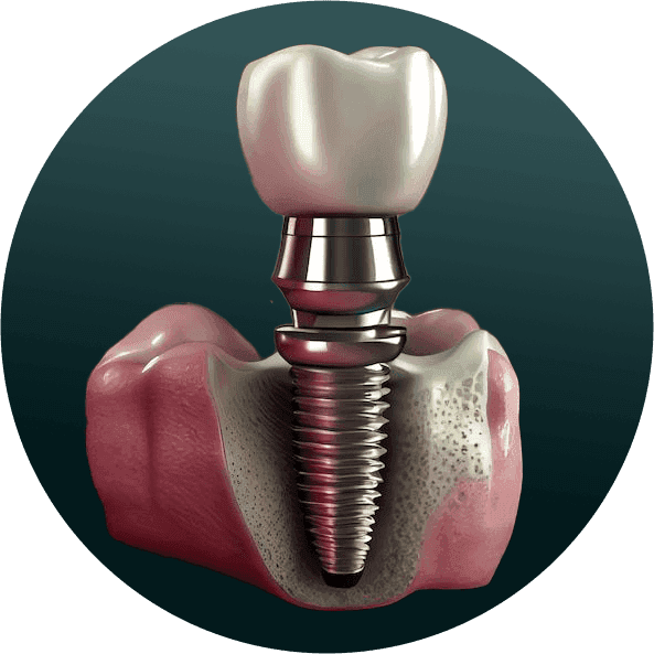 DENTAL VENEERS