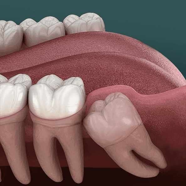 WISDOM TOOTH EXTRACTION