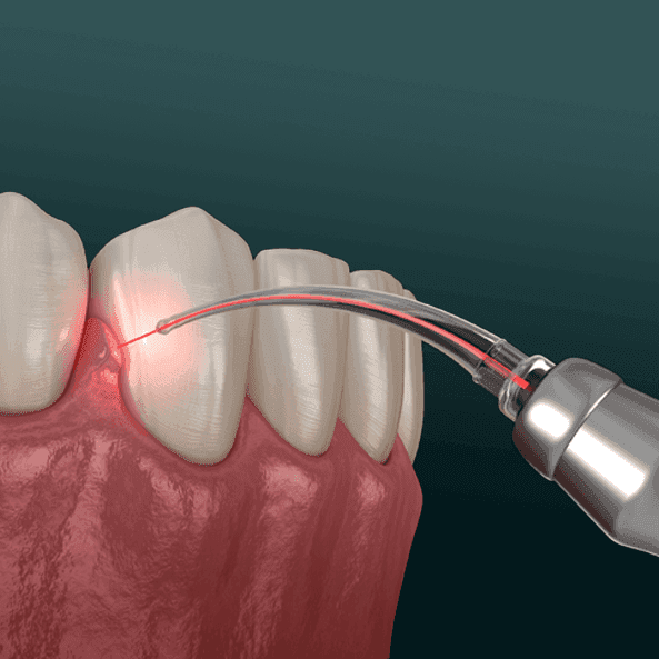 LASER DENTISTRY