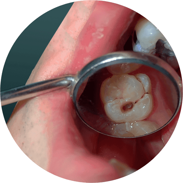 Dental Filling1.png