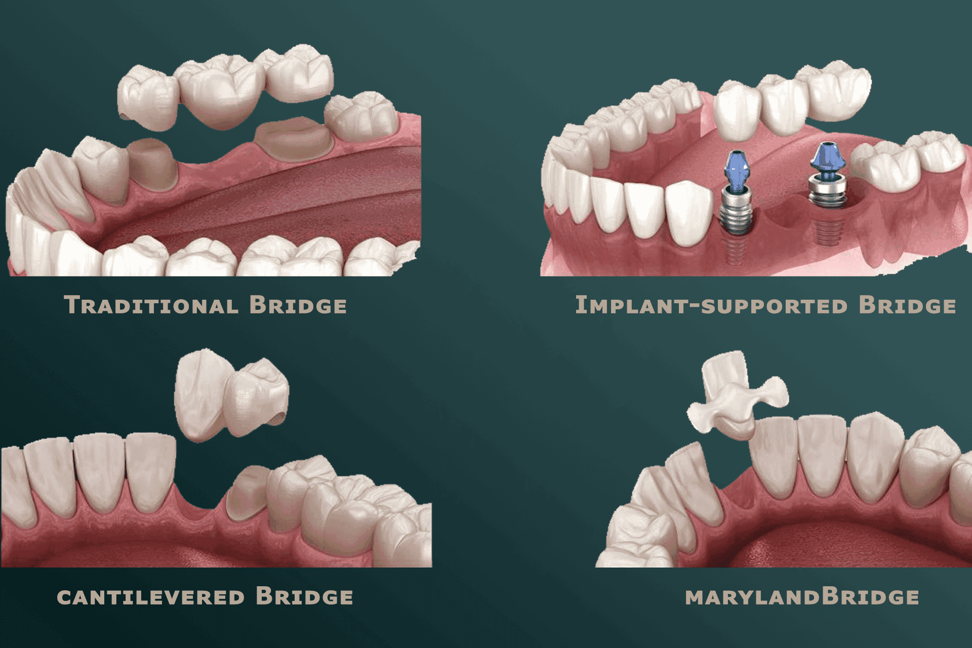 Dental Bridges-min.png