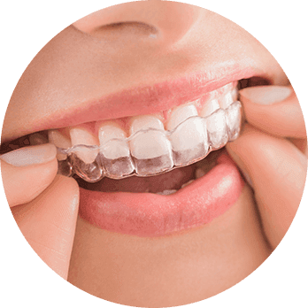 Invisalign-02.png