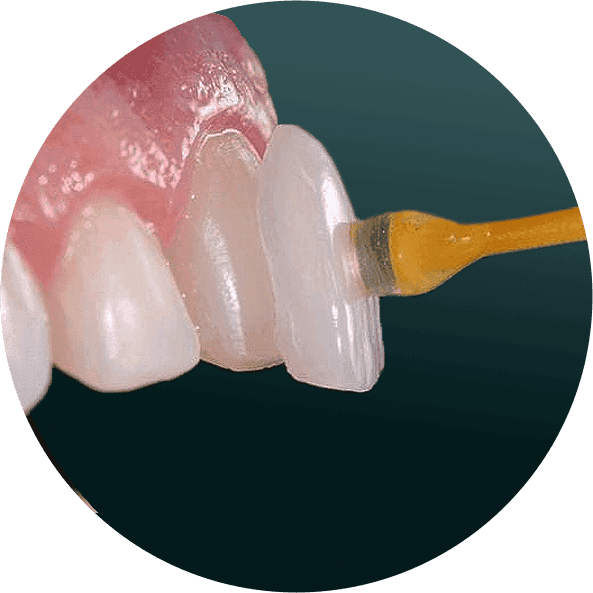 Veneer3-min.png