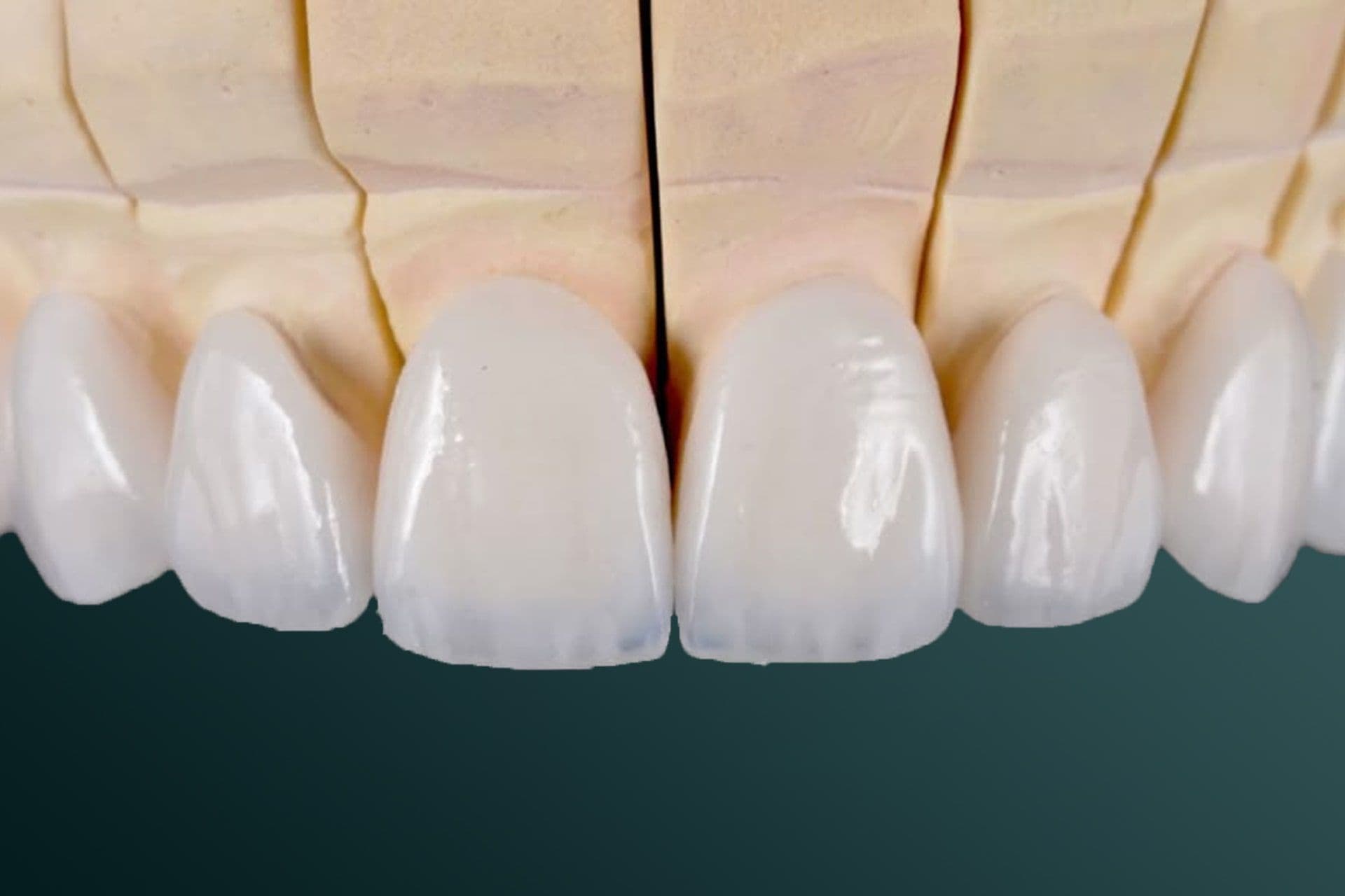 Veneer6-min.jpg