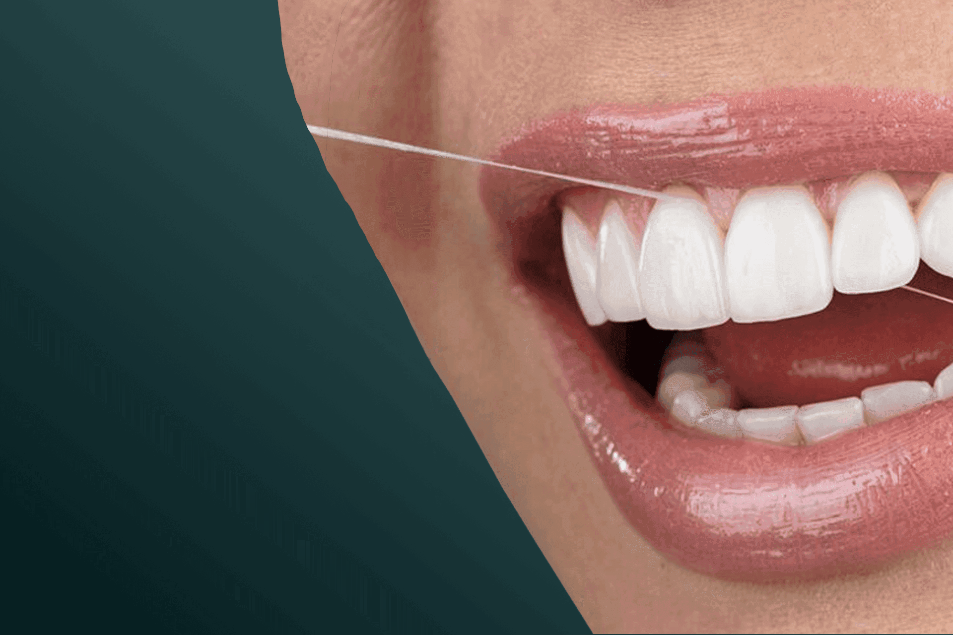 Veneer4-min.png