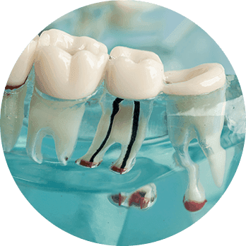 Root Canal-1.png