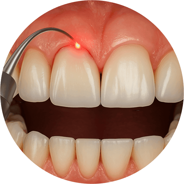 Gingivoplasty.png