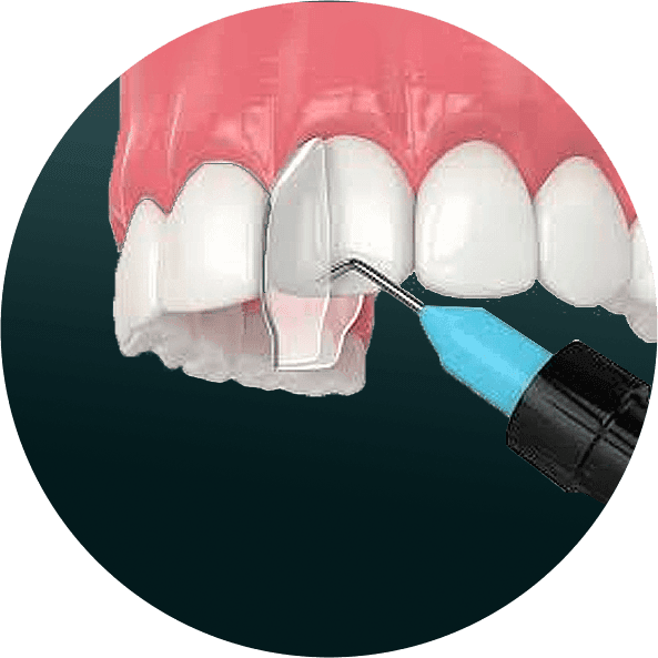 Composite Bonding-3.png
