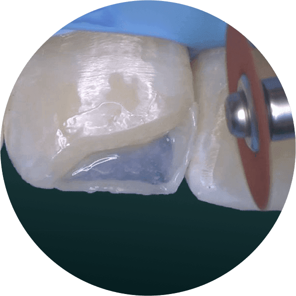 Composite Bonding-1.png