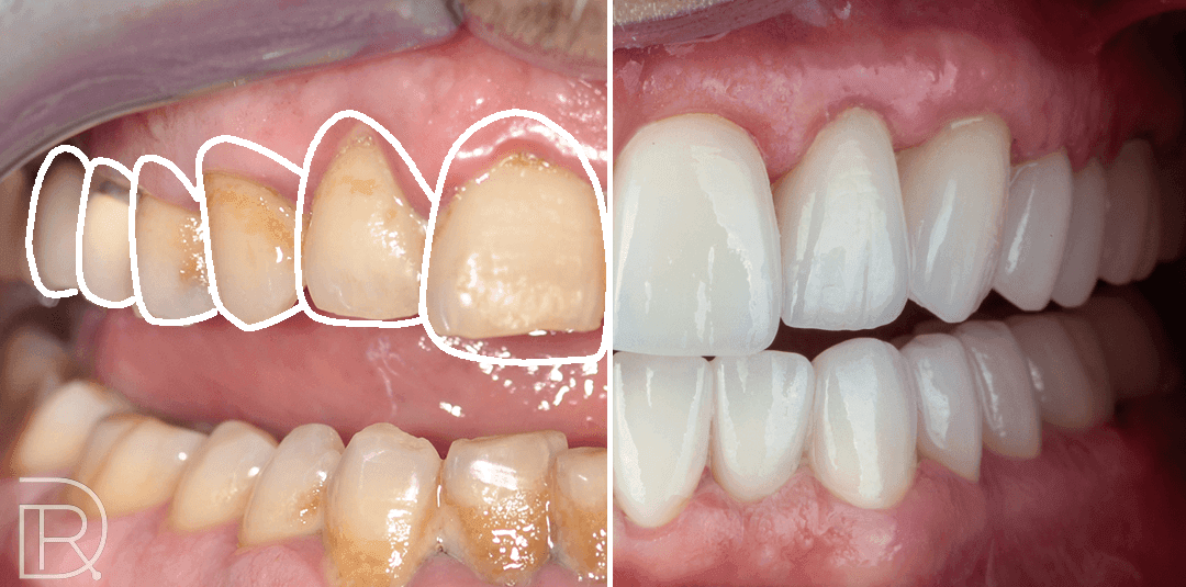 Gummy Smile-1 (1).png