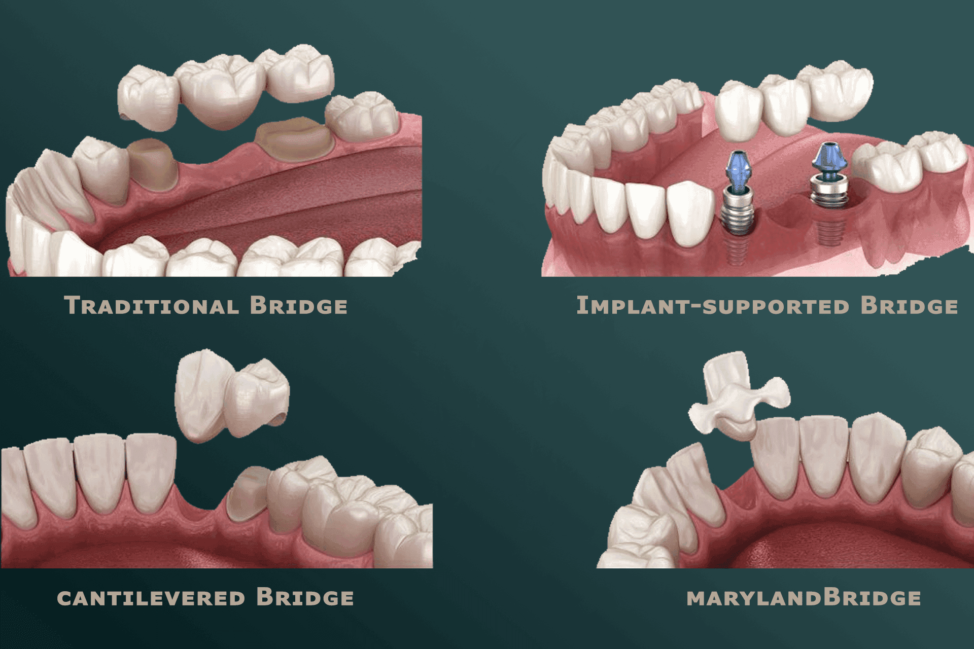 Dental Bridges-min.png