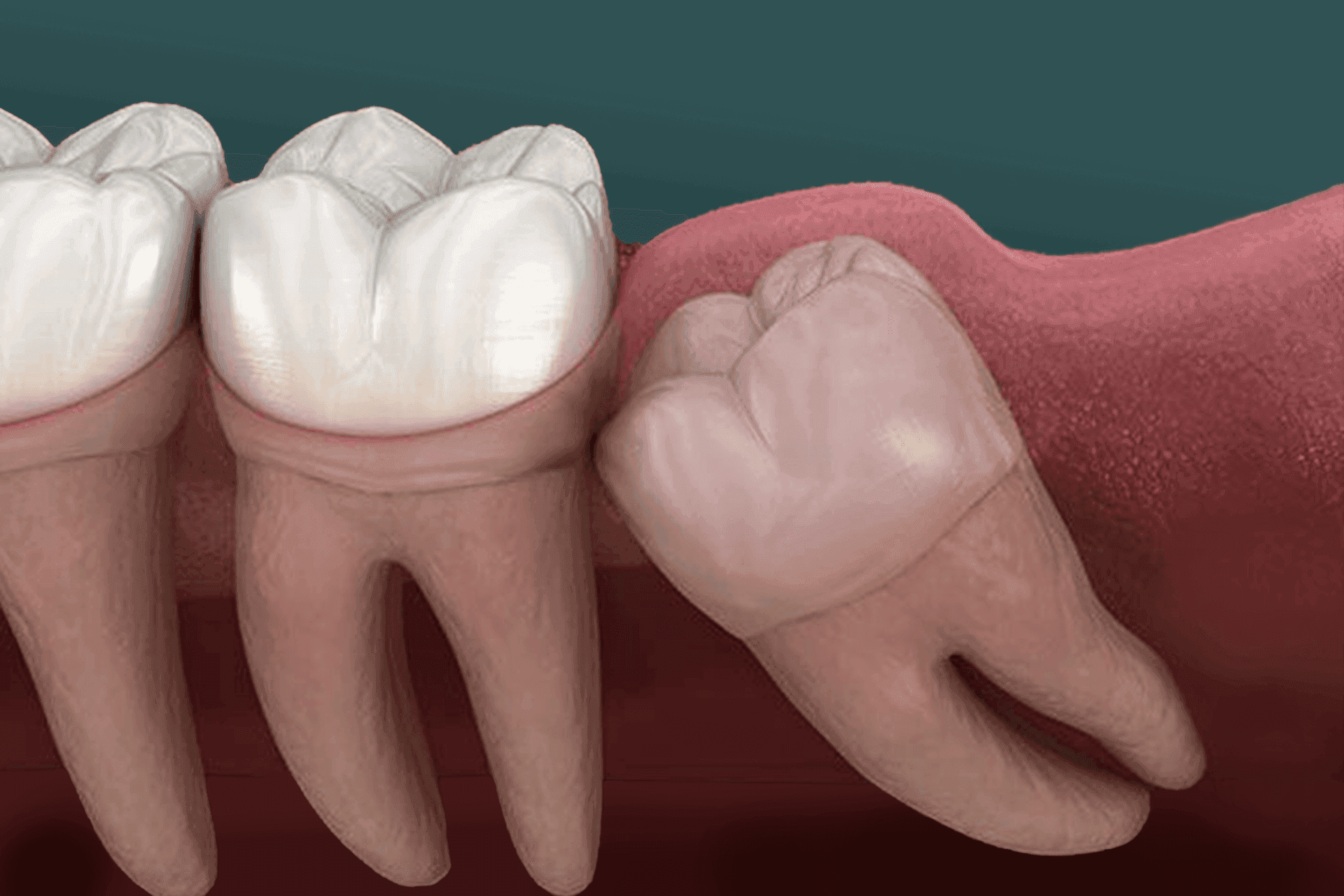 Wisdom Tooth1.png