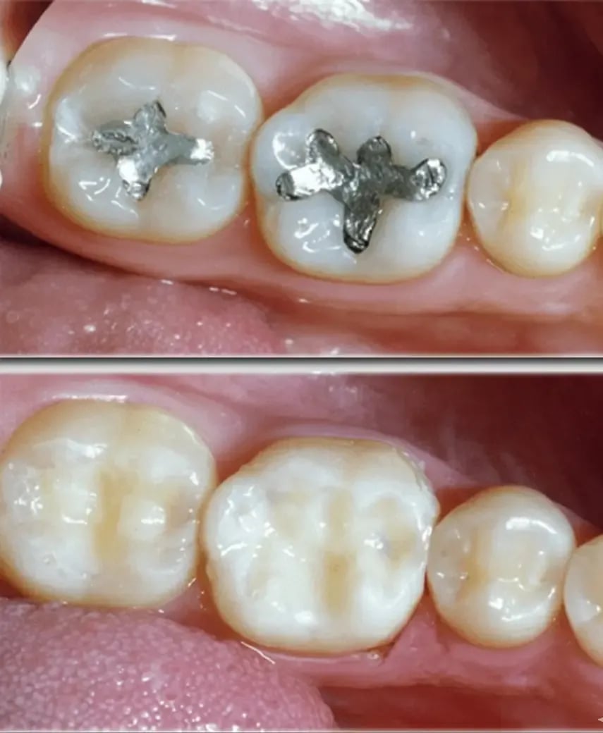 smart amalgam removal.webp