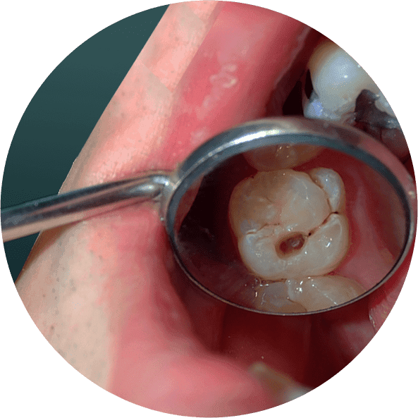 Dental Filling1.png
