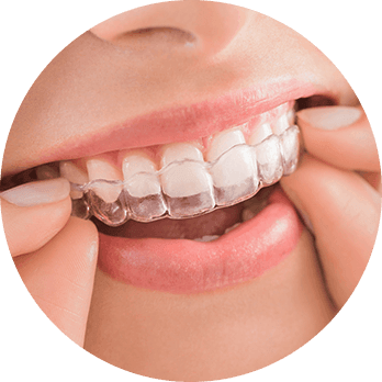 Invisalign-02.png