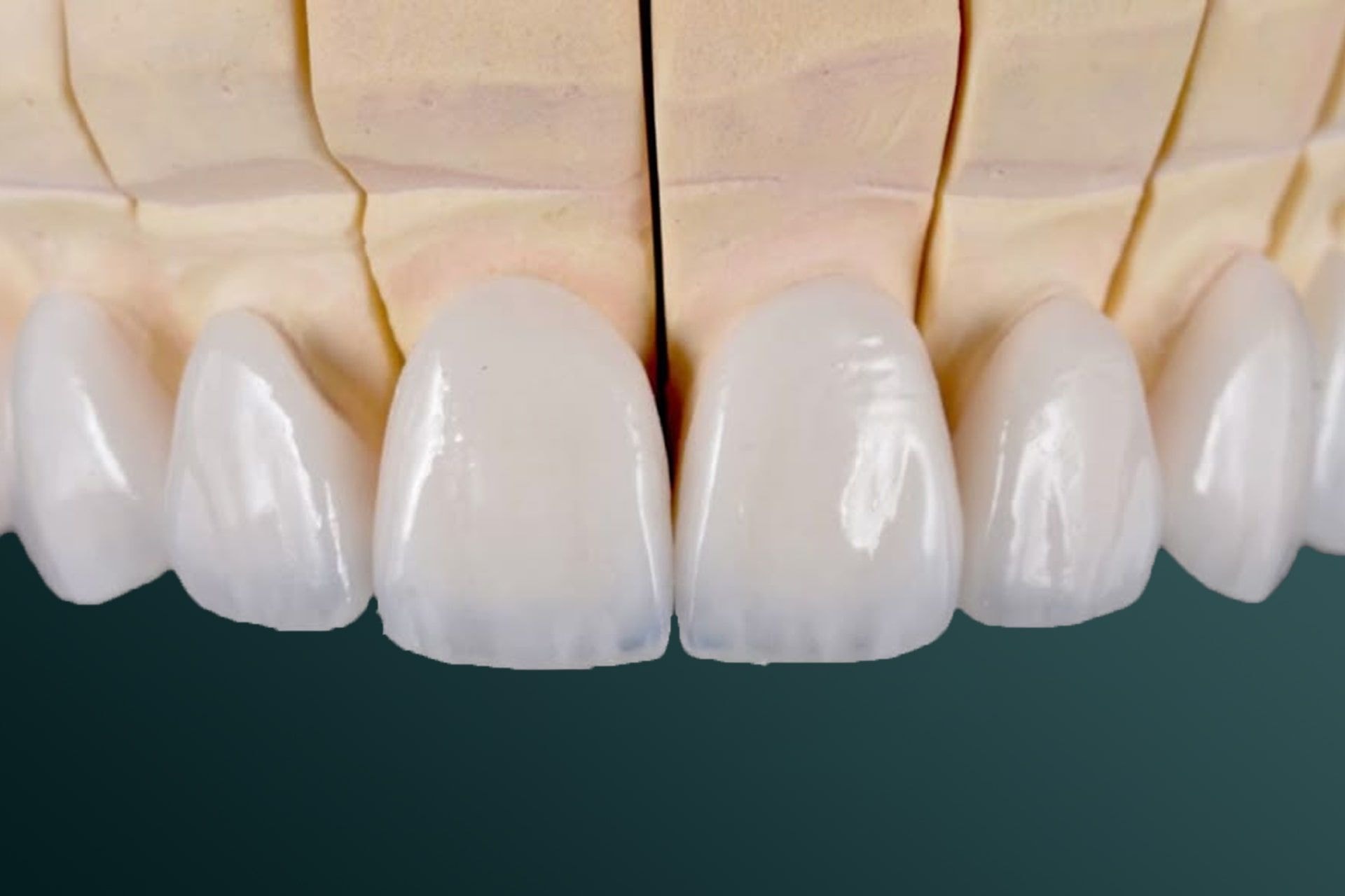 Veneer6-min.jpg