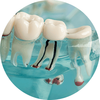 Root Canal-1.png