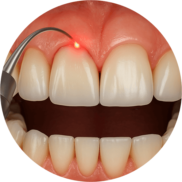 Gingivoplasty.png