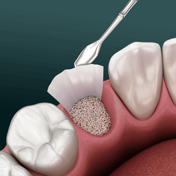 Bone Graft.png