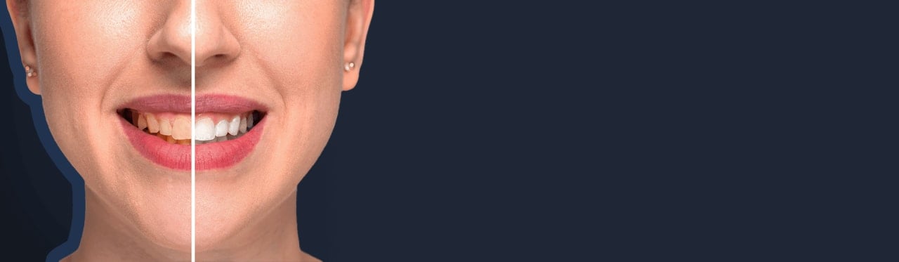 Zahnaufhellung in der Türkei