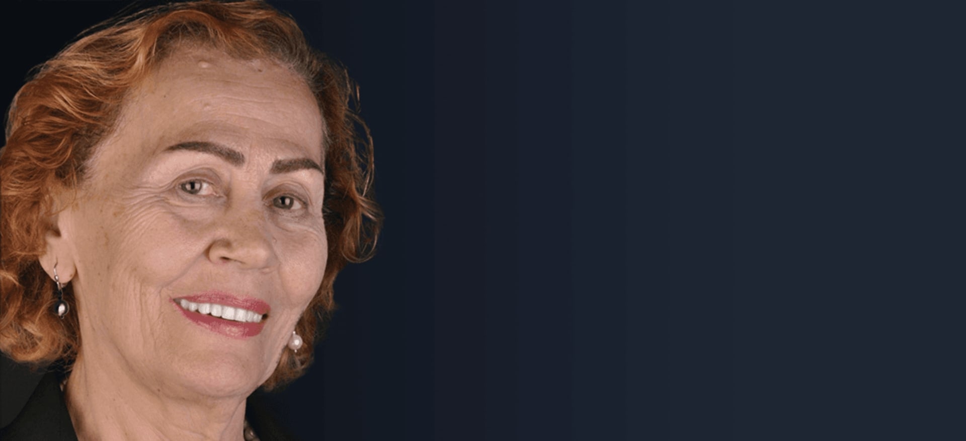 Jochbein-Implantate in Istanbul, Türkei