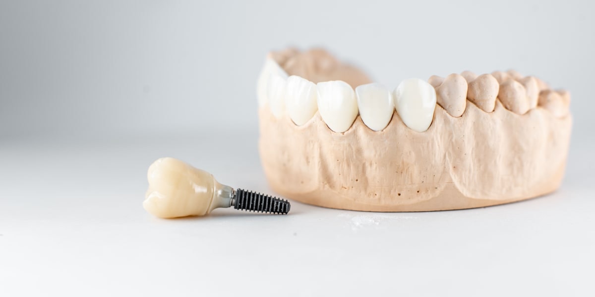 All-on-4 Diş İmplantı
