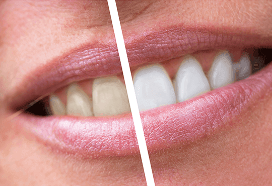 Teeth whitening 3.png