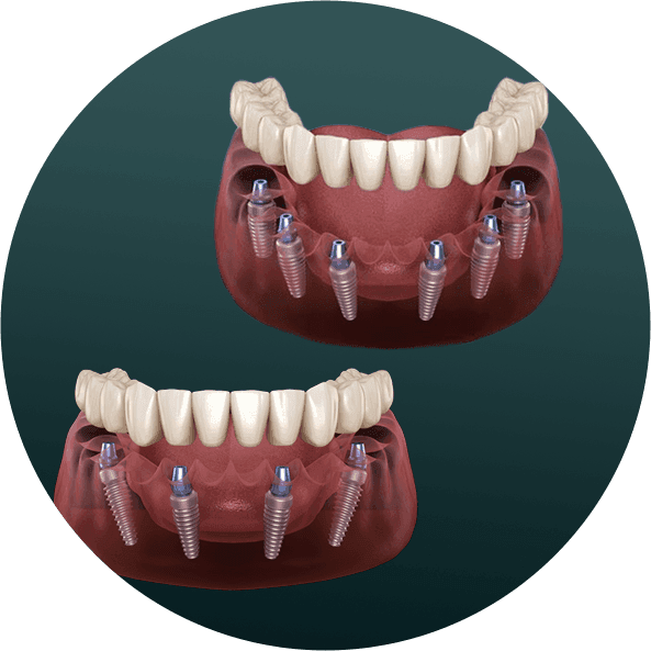 Full Mouth Implant.png