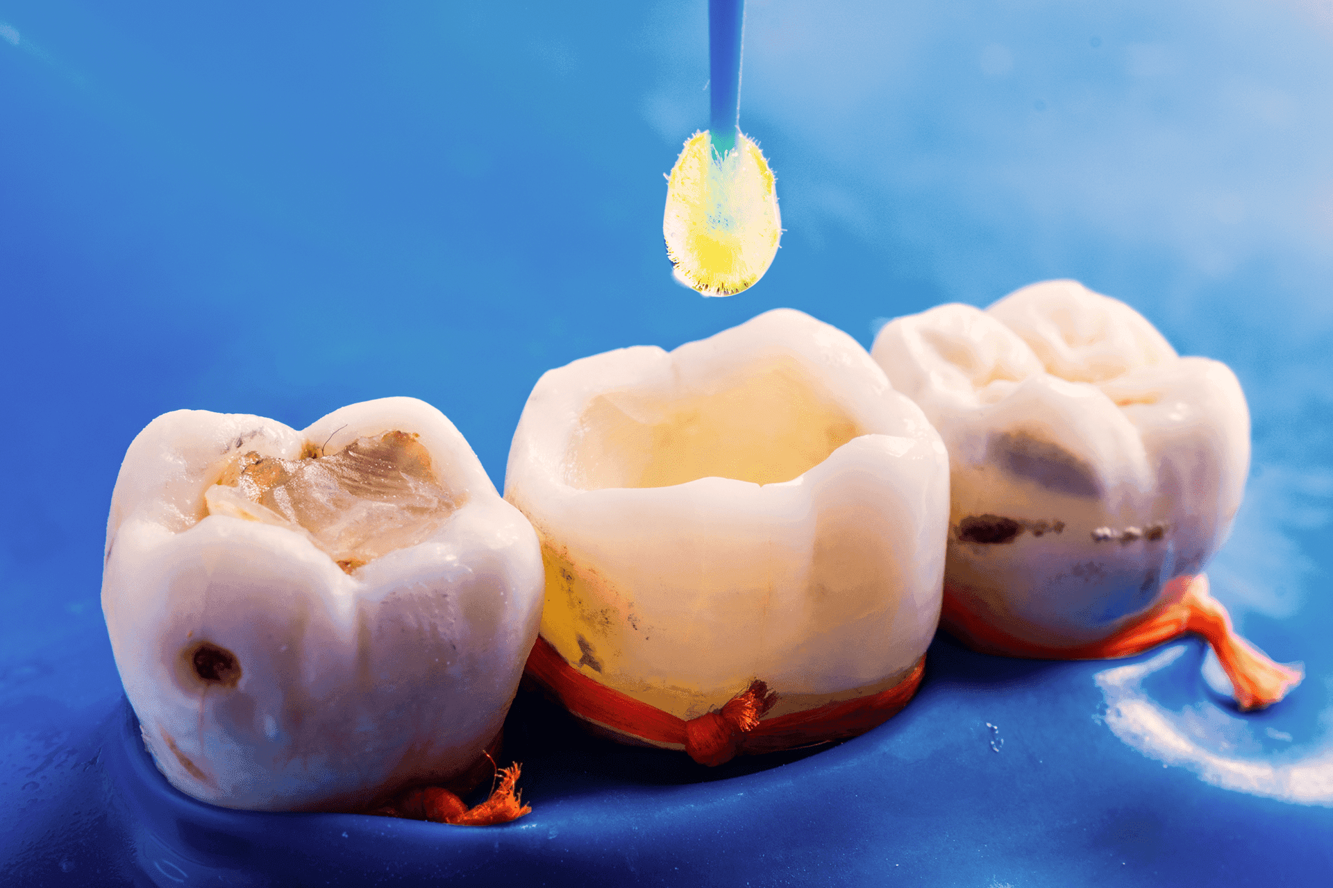 Dental Filling4-min.png