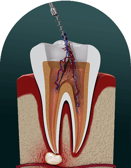 Arch Imaj root canal.png