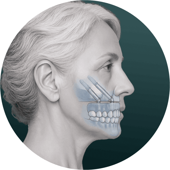 Zygomatic Implants-04.png