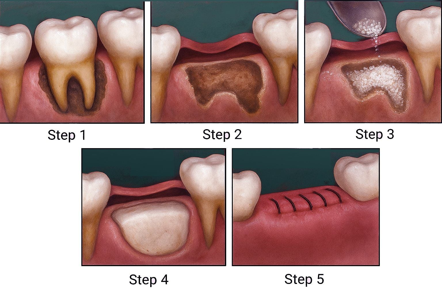 Bone Graft2-compressed.jpg