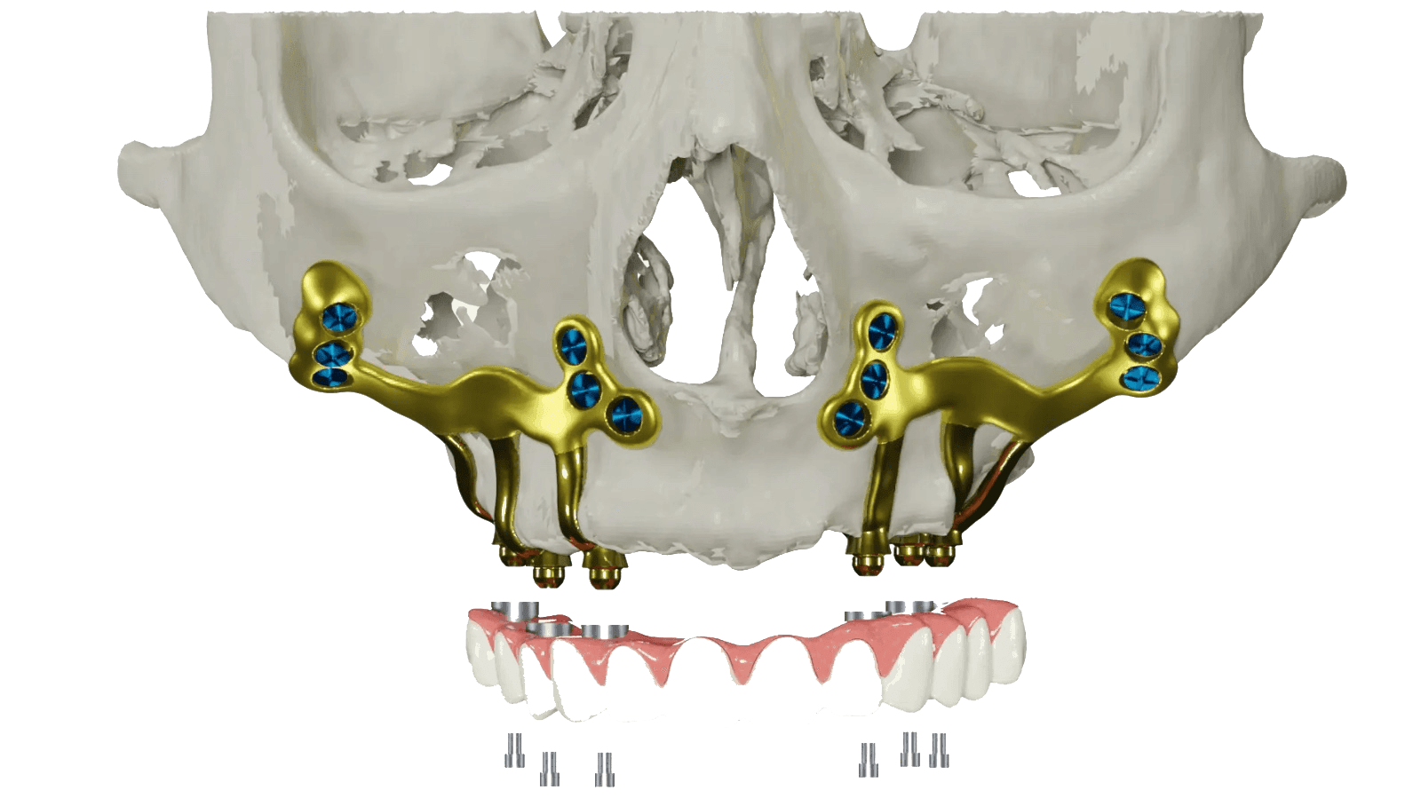 Subperiosteal Implant