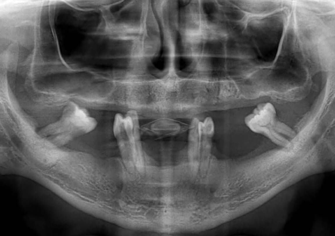 Subperiosteal Implant patient