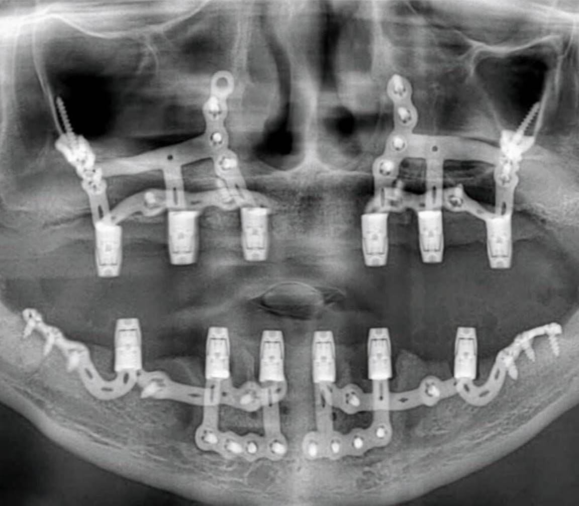 Subperiosteal Implant X-ray