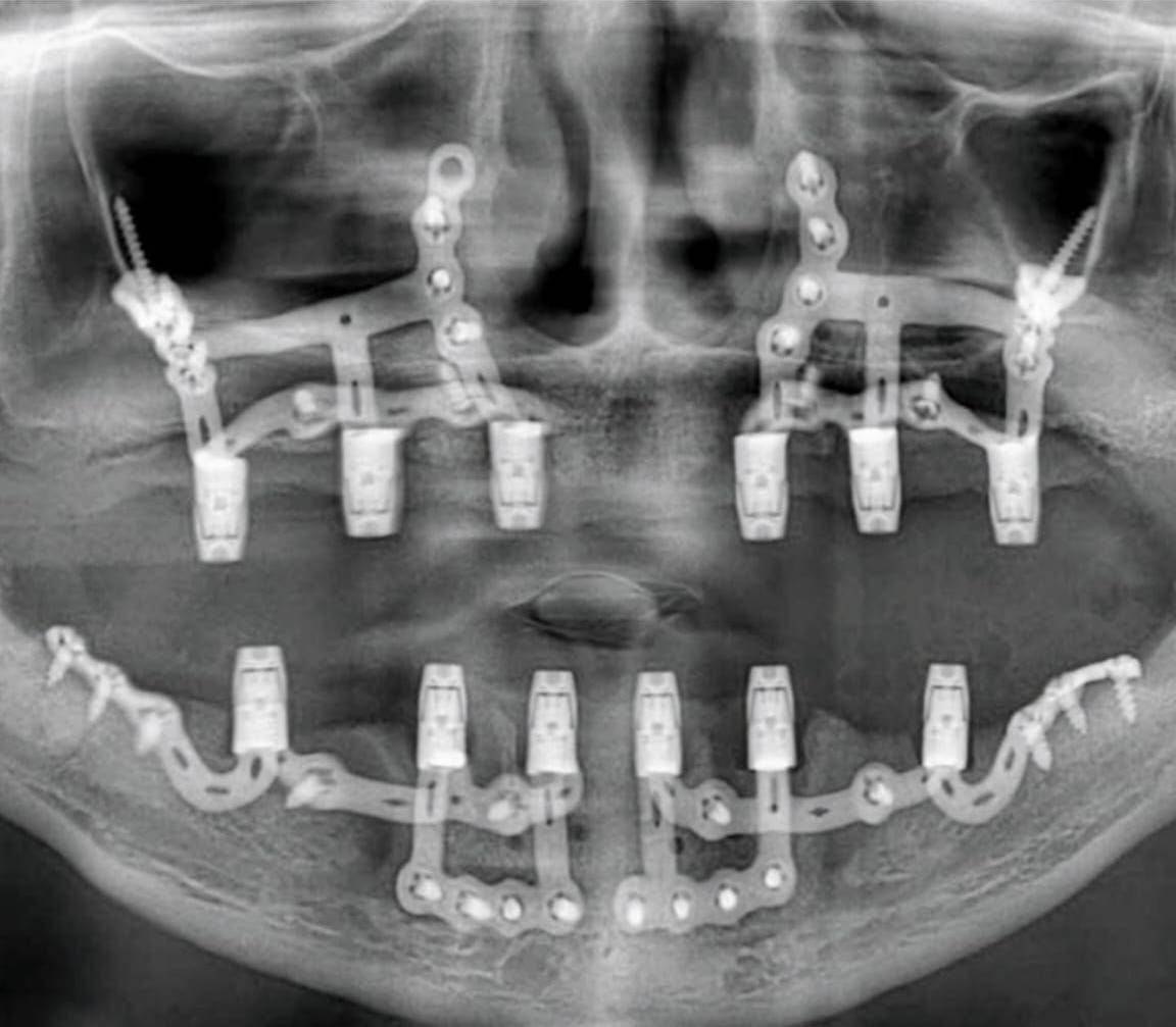 Subperiosteal Implant X-ray